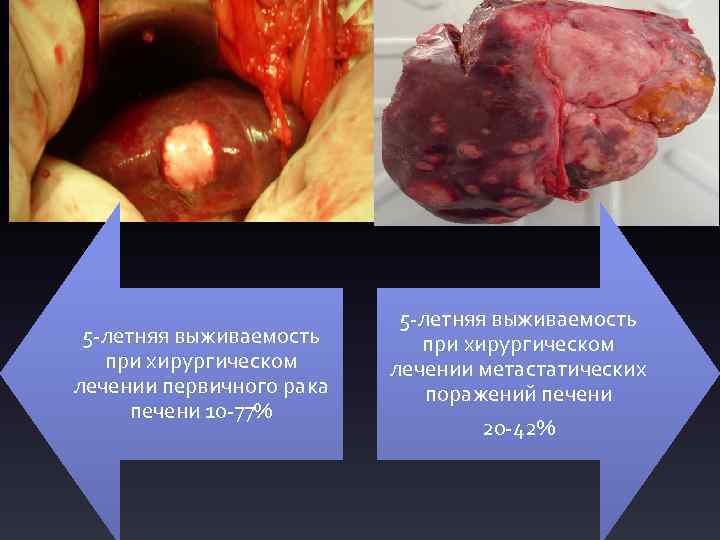 5 -летняя выживаемость при хирургическом лечении первичного рака печени 10 -77% 5 -летняя выживаемость