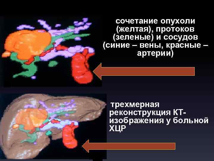 а- сочетание опухоли (желтая), протоков (зеленые) и сосудов (синие – вены, красные – артерии)