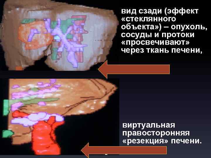 вид сзади (эффект «стеклянного объекта» ) – опухоль, сосуды и протоки «просвечивают» через ткань