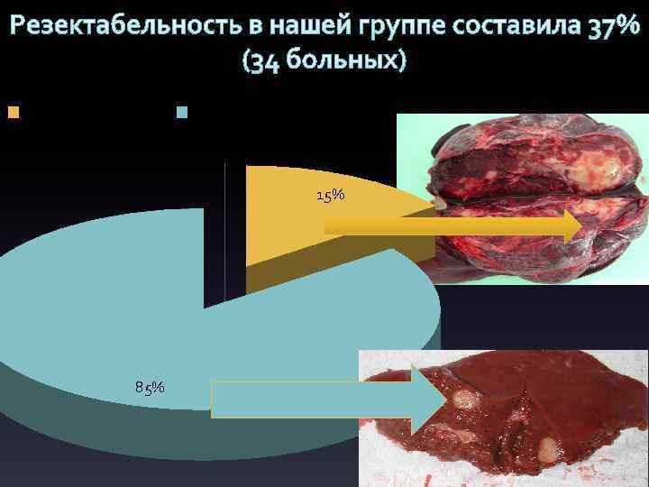 Резектабельность в нашей группе составила 37% (34 больных) первичные опухоли метастатические опухоли 15% 85%