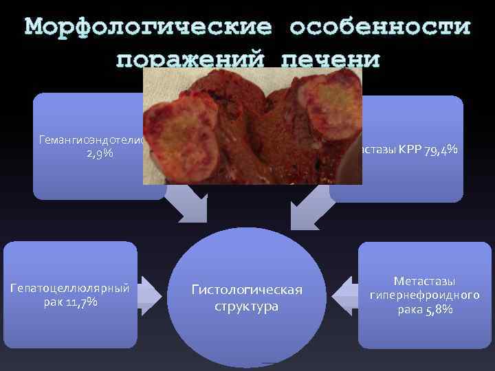 Морфологические особенности поражений печени Гемангиоэндотелиома 2, 9% Гепатоцеллюлярный рак 11, 7% Метастазы КРР 79,