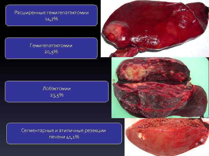 Расширенные гемигепатэктомии 14, 7% Гемигепатэктомии 20, 5% Лобэктомии 23, 5% Сегментарные и атипичные резекции