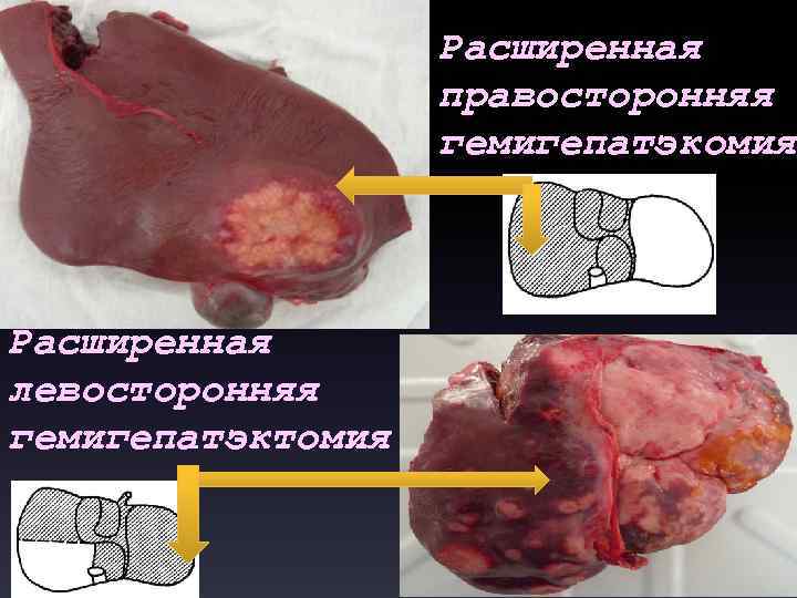 Расширенная правосторонняя гемигепатэкомия Расширенная левосторонняя гемигепатэктомия 