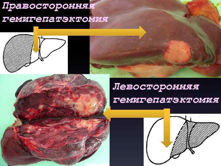 Правосторонняя гемигепатэктомия Левосторонняя гемигепатэктомия 