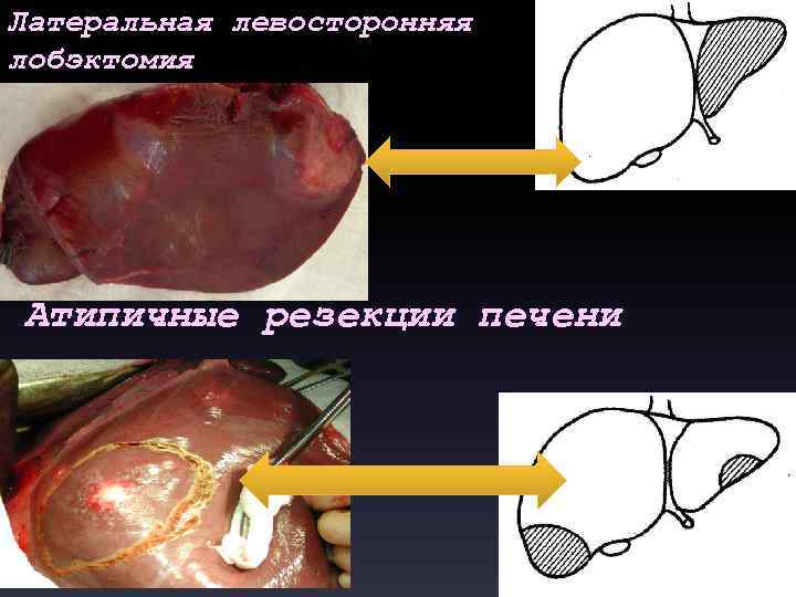 Латеральная левосторонняя лобэктомия Атипичные резекции печени 