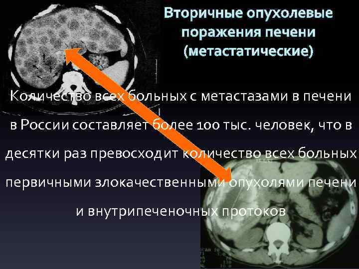 Вторичные опухолевые поражения печени (метастатические) Количество всех больных с метастазами в печени в России