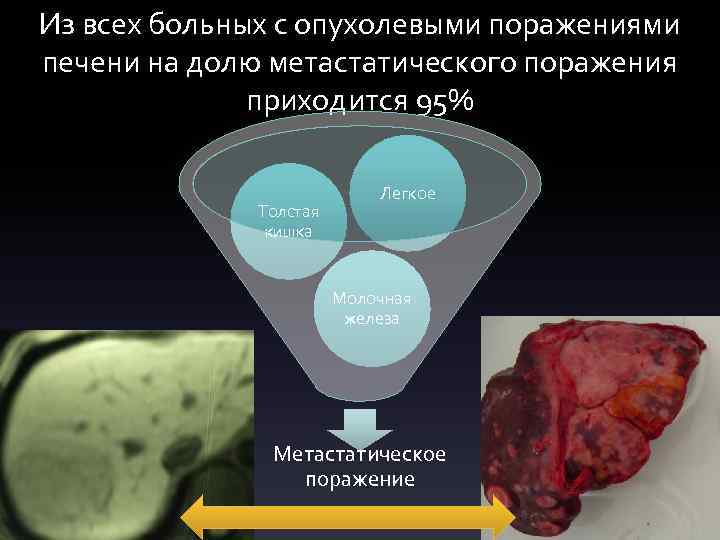 Из всех больных с опухолевыми поражениями печени на долю метастатического поражения приходится 95% Толстая