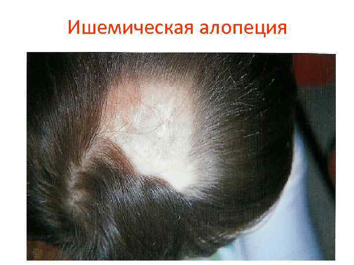 Ишемическая алопеция 