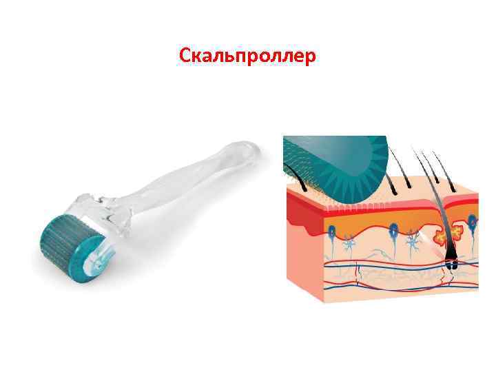 Скальпроллер 