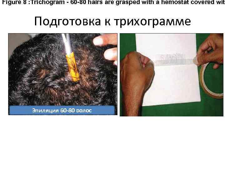 Figure 8 : Trichogram - 60 -80 hairs are grasped with a hemostat covered