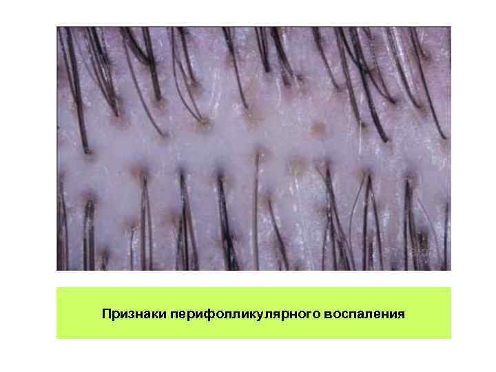 Признаки перифолликулярного воспаления 