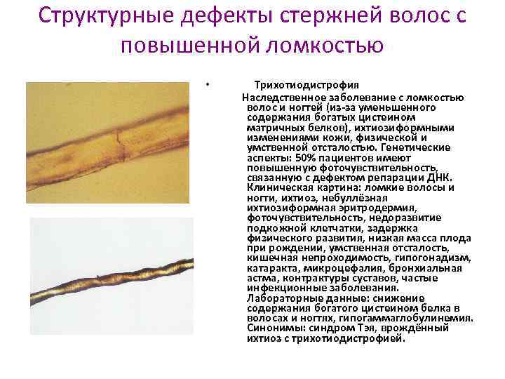 Структурные дефекты стержней волос с повышенной ломкостью • Трихотиодистрофия Наследственное заболевание с ломкостью волос