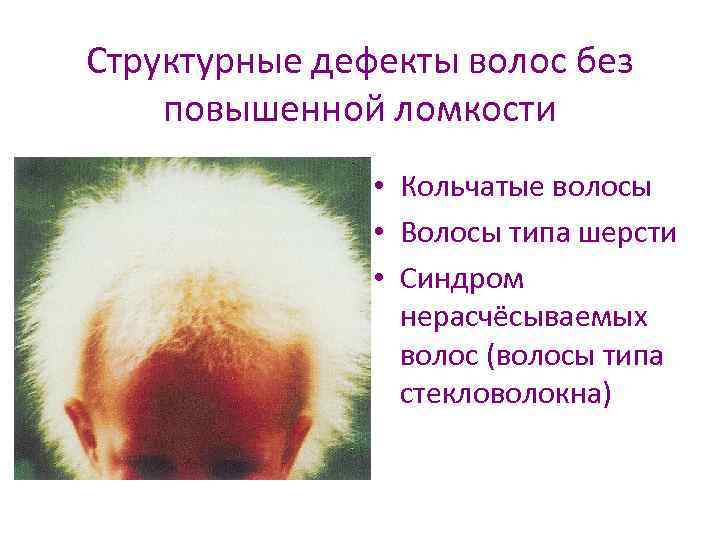 Структурные дефекты волос без повышенной ломкости • Кольчатые волосы • Волосы типа шерсти •