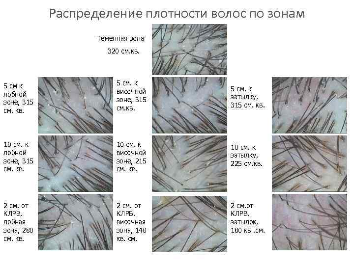Распределение плотности волос по зонам Теменная зона 320 см. кв. 5 см к лобной