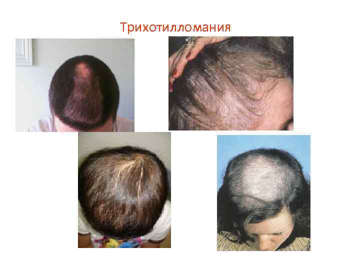 Трихотилломания 