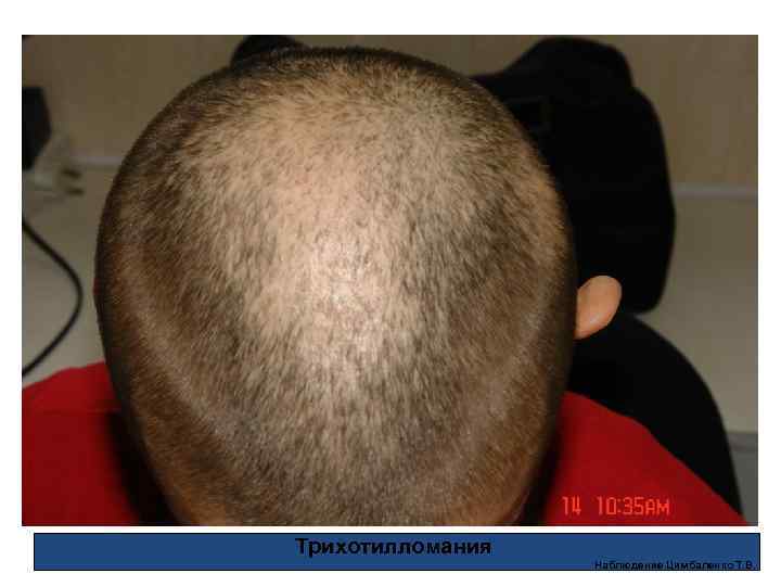Трихотилломания Наблюдение Цимбаленко Т. В. 