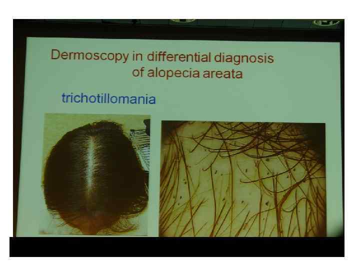 A. Tosty. Dermatoscopy in the diagnosis of hair disease. Department of Dermatology University of