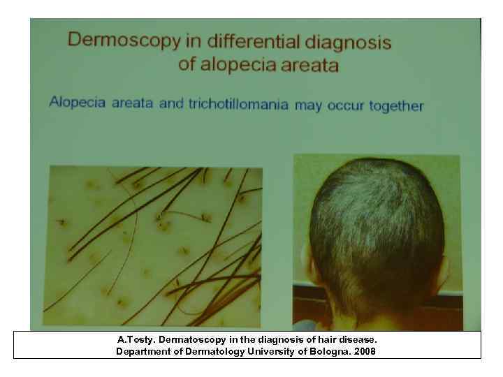 A. Tosty. Dermatoscopy in the diagnosis of hair disease. Department of Dermatology University of