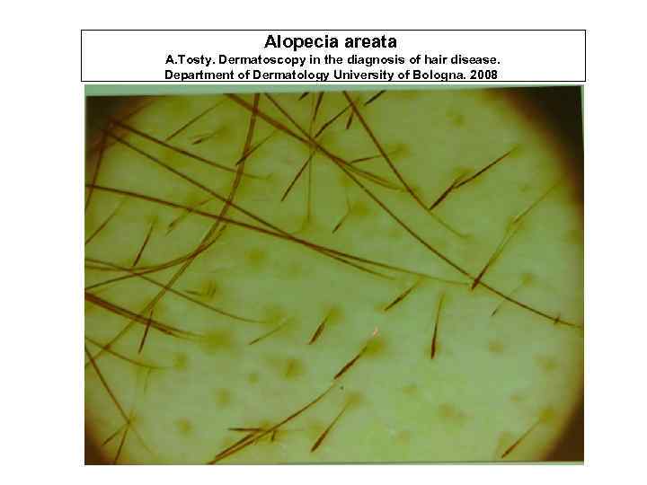 Alopecia areata A. Tosty. Dermatoscopy in the diagnosis of hair disease. Department of Dermatology