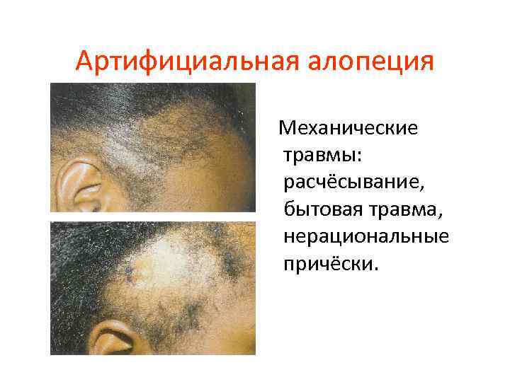 Артифициальная алопеция Механические травмы: расчёсывание, бытовая травма, нерациональные причёски. 