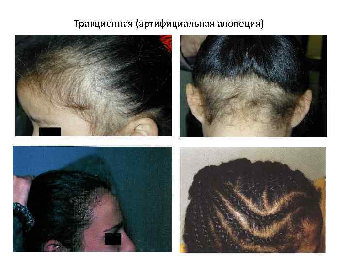 Тракционная (артифициальная алопеция) 