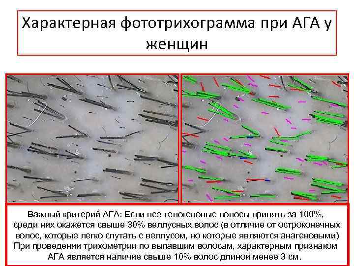 Характерная фототрихограмма при АГА у женщин Важный критерий АГА: Если все телогеновые волосы принять