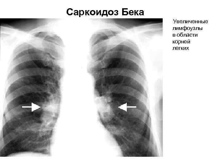 Корни легких усилены. Саркоидоз рентген грудной клетки. Саркоидоз внутригрудных лимфоузлов рентген. Саркоидоз легких 2 ст рентген. Саркоидоз флюорография.