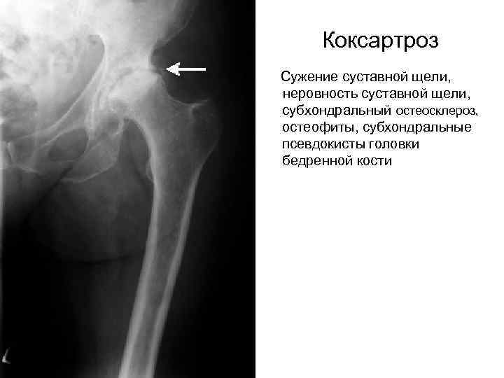  Коксартроз Сужение суставной щели, неровность суставной щели, субхондральный остеосклероз, остеофиты, субхондральные псевдокисты головки