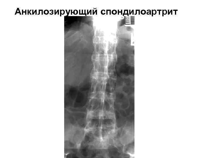 Анкилозирующий спондилоартрит 