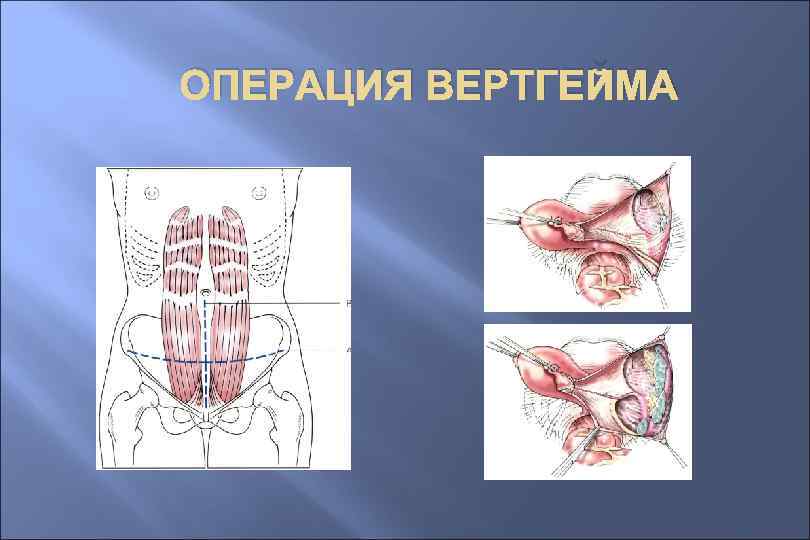 ОПЕРАЦИЯ ВЕРТГЕЙМА 