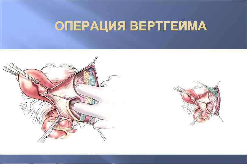 ОПЕРАЦИЯ ВЕРТГЕЙМА 