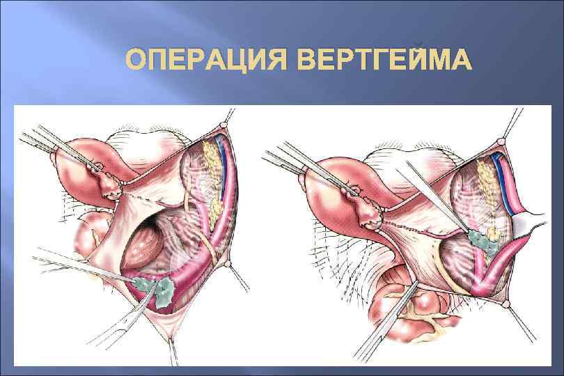 ОПЕРАЦИЯ ВЕРТГЕЙМА 