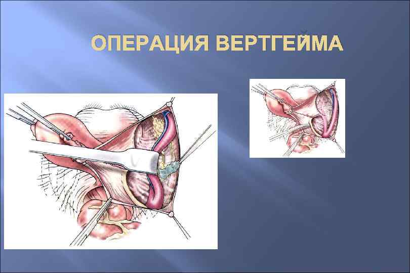 ОПЕРАЦИЯ ВЕРТГЕЙМА 