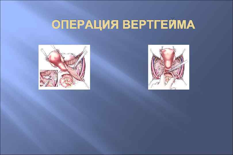 ОПЕРАЦИЯ ВЕРТГЕЙМА 