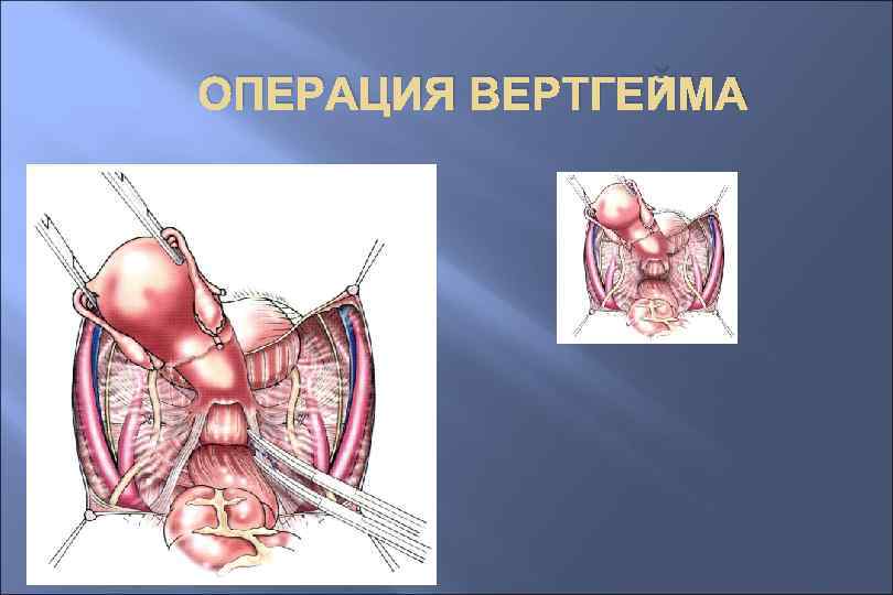 ОПЕРАЦИЯ ВЕРТГЕЙМА 