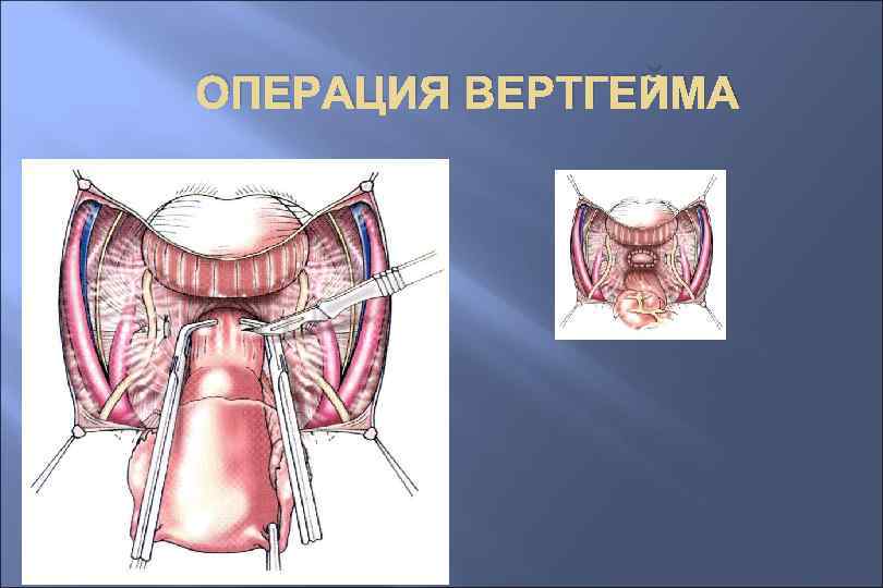 ОПЕРАЦИЯ ВЕРТГЕЙМА 