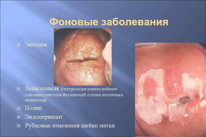 Фоновые заболевания Эктопия Лейкоплакия (гиперплазия многослойного плоского эпителия без явлений атипии клеточных элементов) Полип