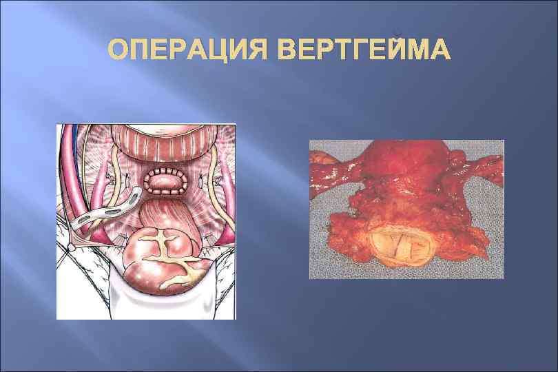 ОПЕРАЦИЯ ВЕРТГЕЙМА 