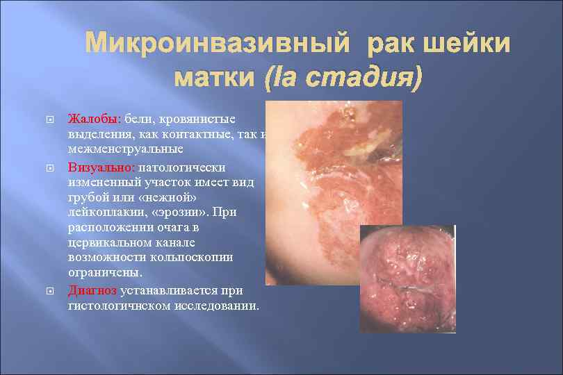 Микроинвазивный рак шейки матки (Ia стадия) Жалобы: бели, кровянистые выделения, как контактные, так и