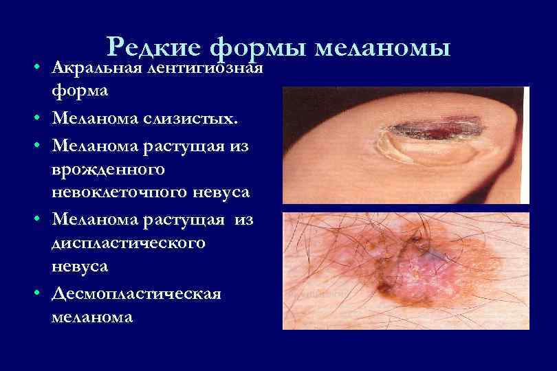 Меланома кожи фото и лечение