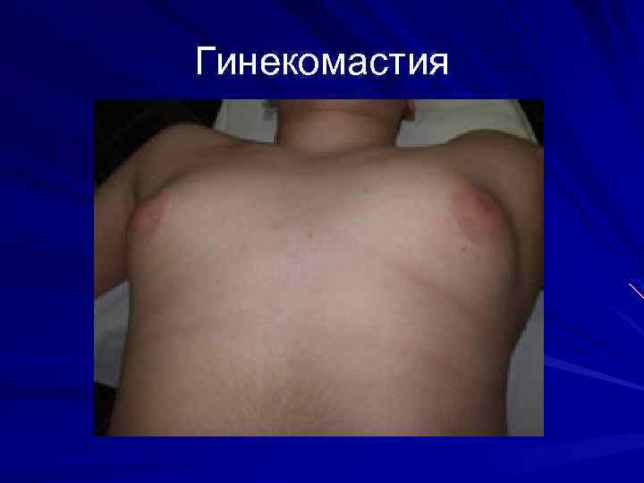 Гинекомастия 