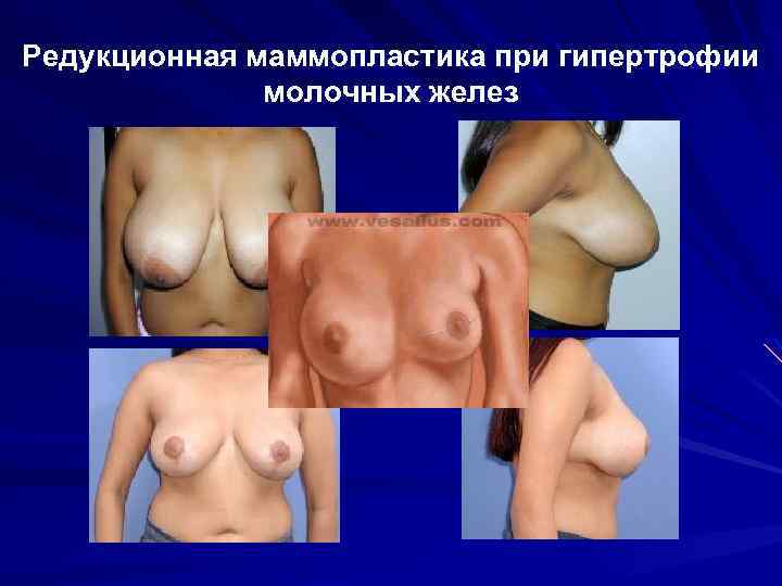 Редукционная маммопластика при гипертрофии молочных желез 
