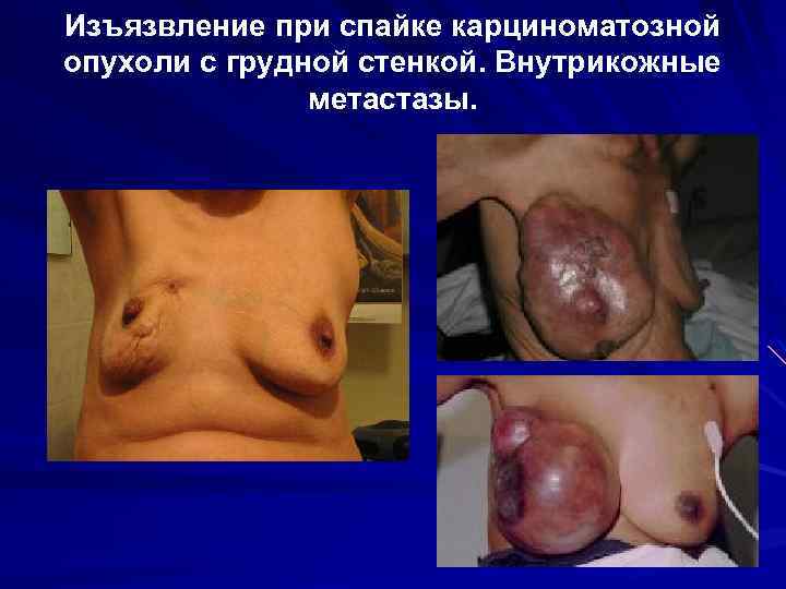 Изъязвление при спайке карциноматозной опухоли с грудной стенкой. Внутрикожные метастазы. 