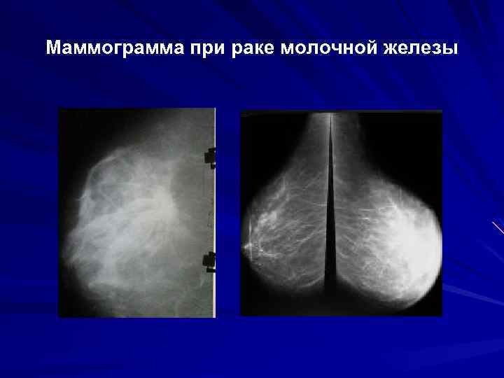 Маммограмма при раке молочной железы 