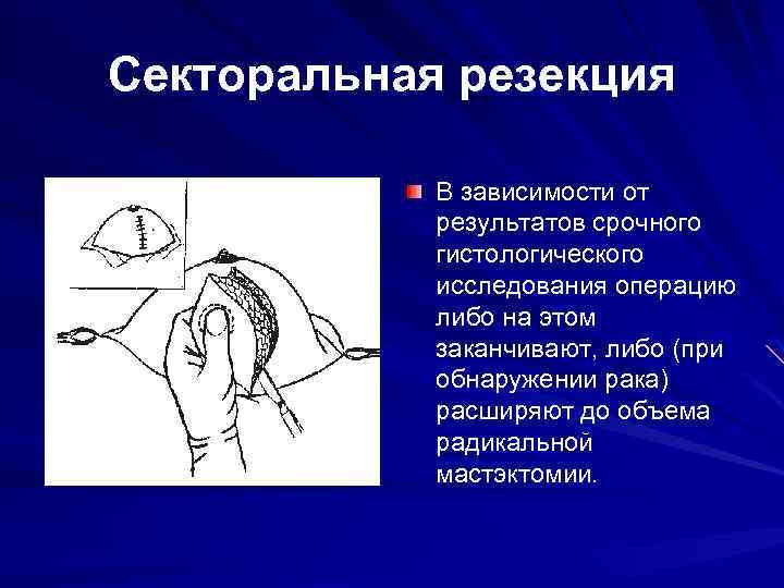 Секторальная резекция В зависимости от результатов срочного гистологического исследования операцию либо на этом заканчивают,