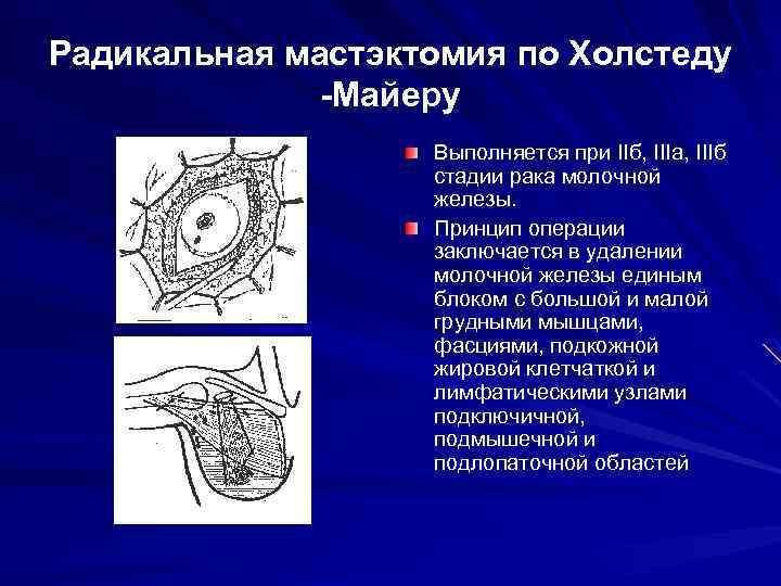 Радикальная мастэктомия по Холстеду -Майеру Выполняется при IIб, IIIа, IIIб стадии рака молочной железы.