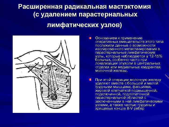Расширенная радикальная мастэктомия (с удалением парастернальных лимфатических узлов) Основанием к применению оперативных вмешательств этого