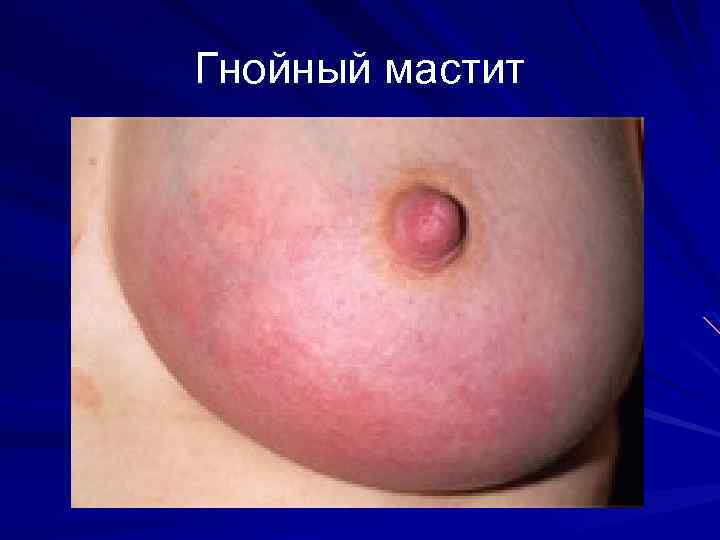 Гнойный мастит 