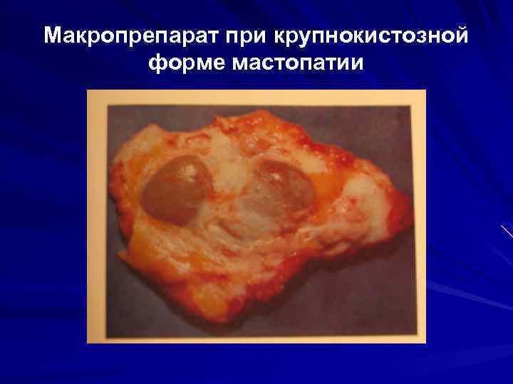 Макропрепарат при крупнокистозной форме мастопатии 