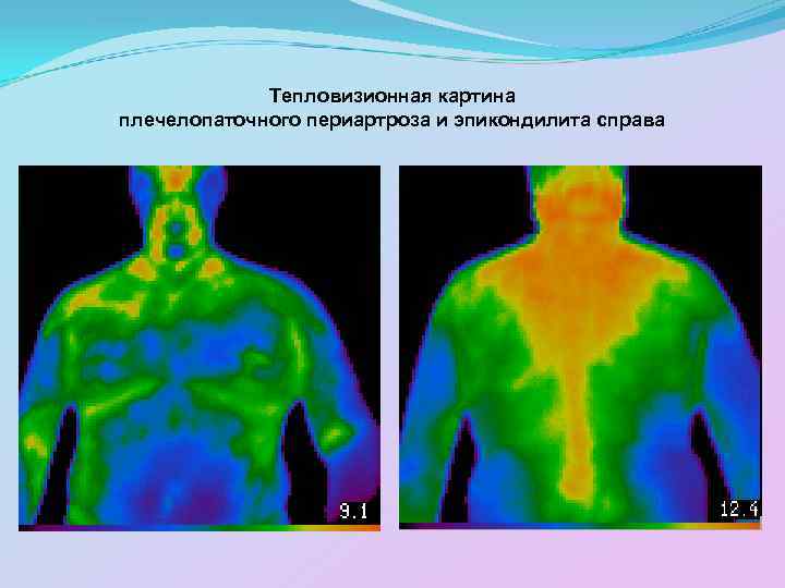 Тепловизионная картина плечелопаточного периартроза и эпикондилита справа 